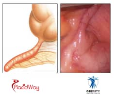 Slider image (3) Obesity Surgical Center | Dr. Jorge Reyes Mendiola